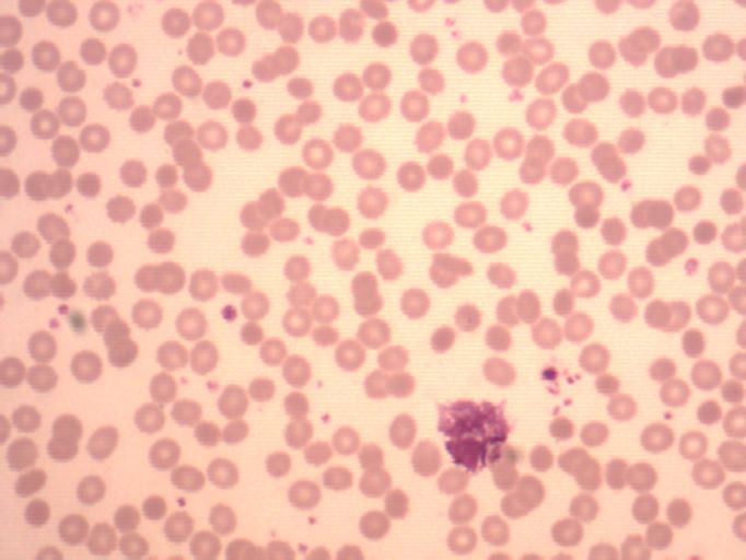 eosinophil