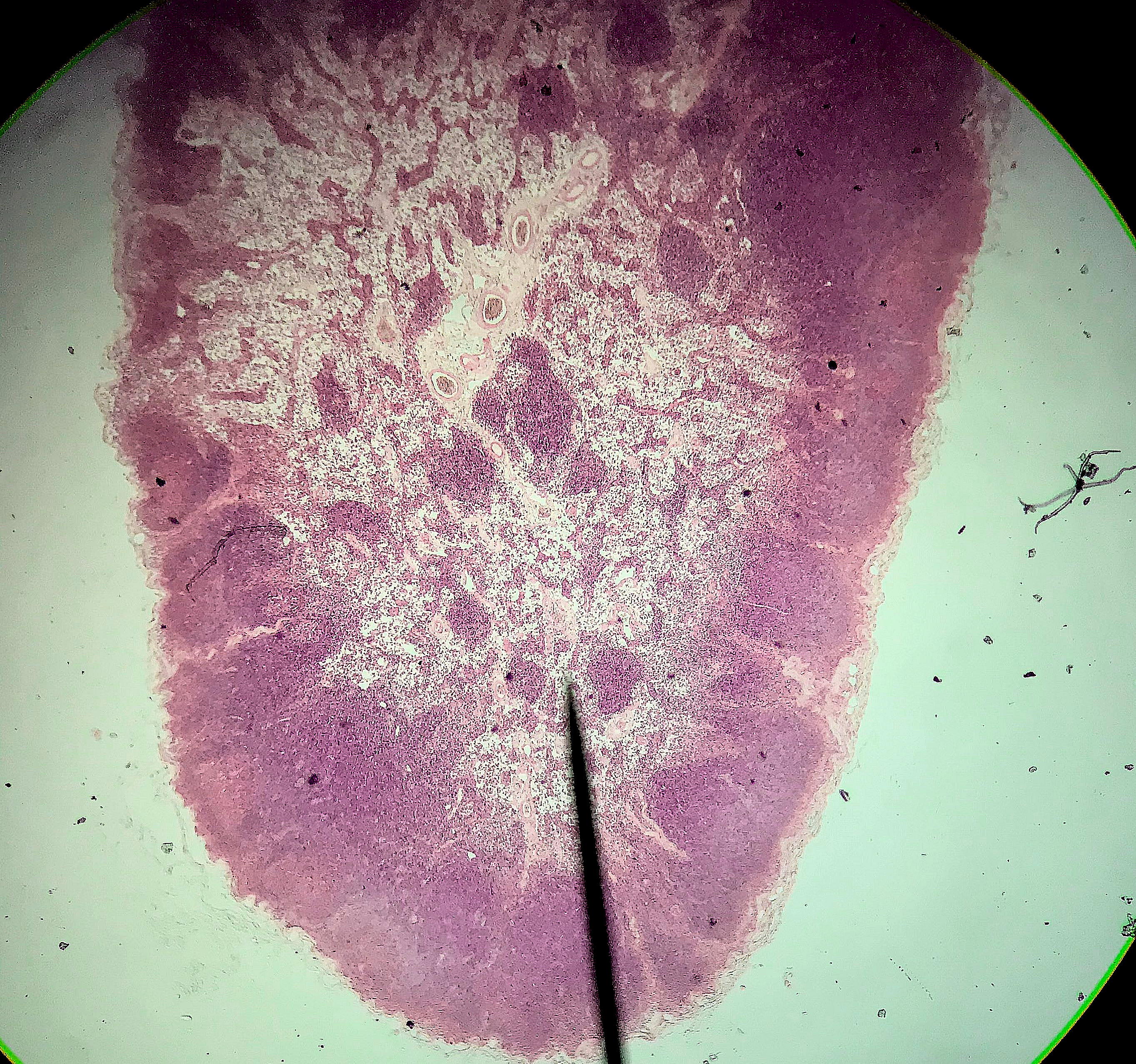 lymph node