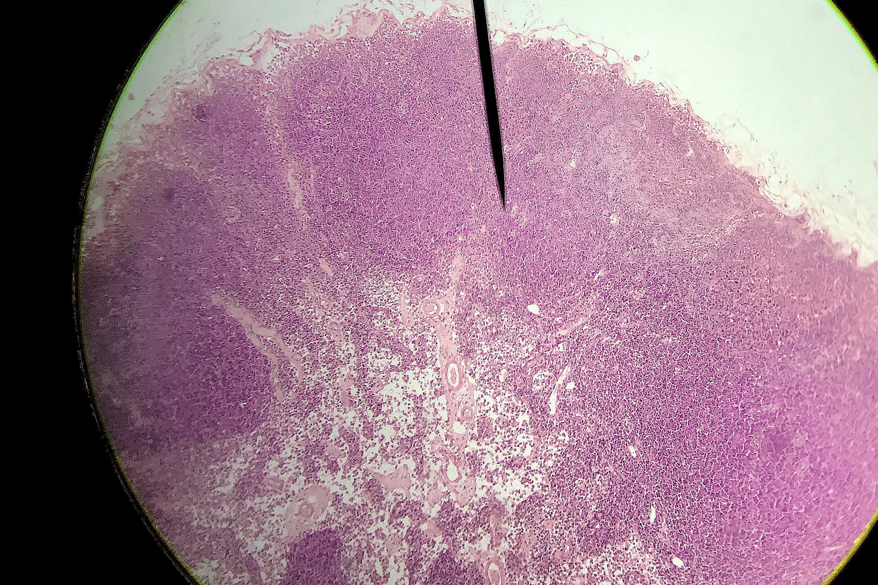 lymph node