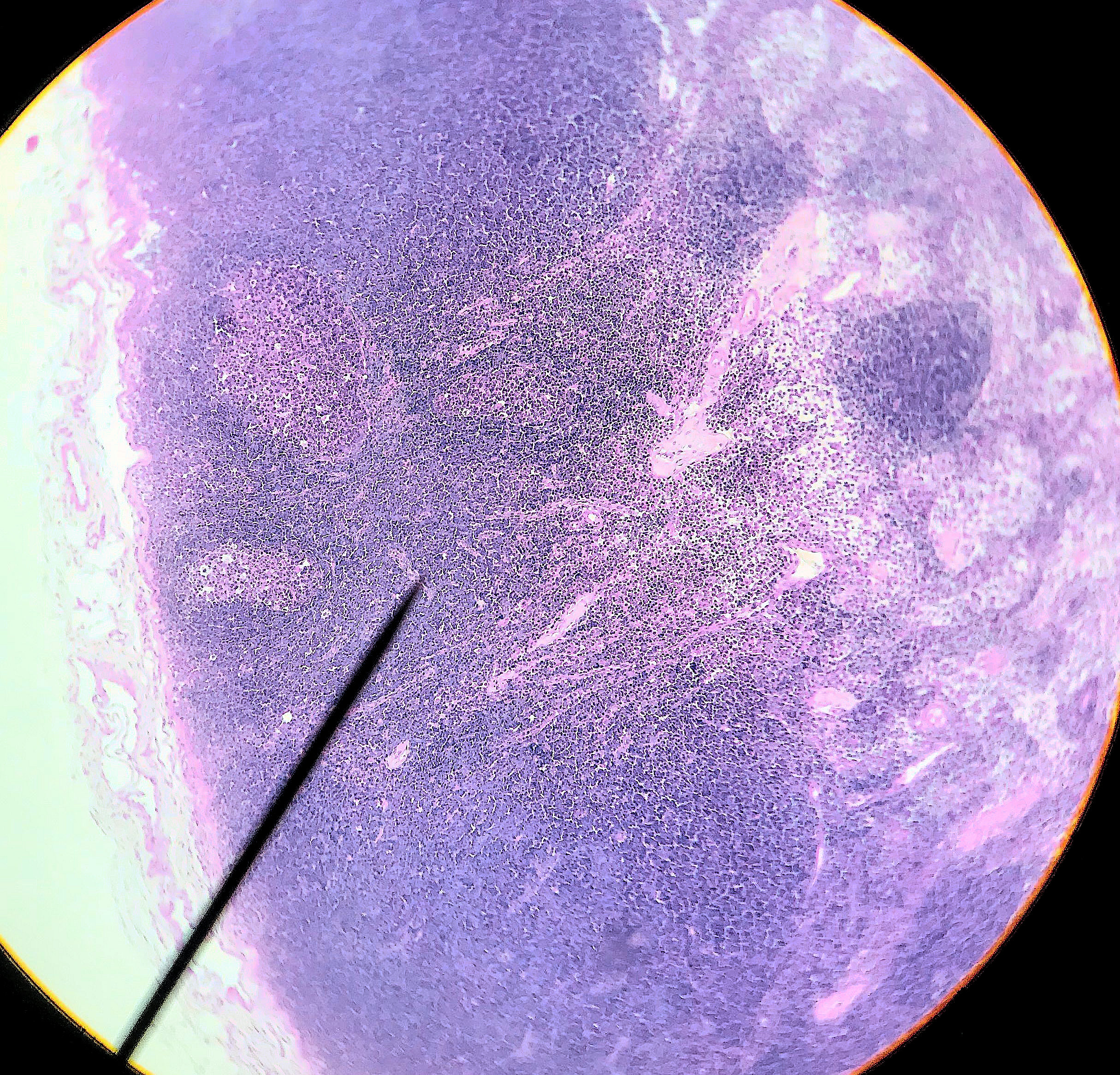 lymph node