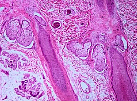 Sebaceous  Gland