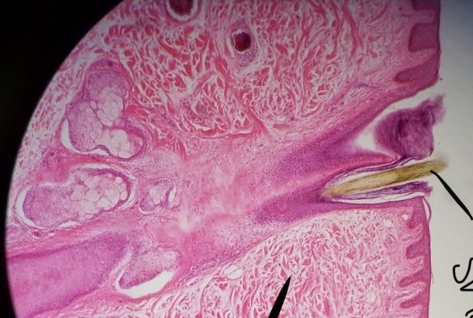 Sebaceous  Gland